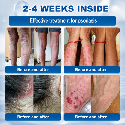 🎊🎊 Clinclii® 𝟕-𝐃𝐚𝐲 𝐒𝐤𝐢𝐧 𝐓𝐚𝐠 & 𝐒𝐩𝐨𝐭 𝐄𝐫𝐚𝐬𝐞𝐫 𝐂𝐫𝐞𝐚𝐦 (𝐙𝐞𝐫𝐨 𝐏𝐚𝐢𝐧, 𝐙𝐞𝐫𝐨 𝐒𝐜𝐚𝐫𝐬 𝐅𝐨𝐫𝐦𝐮𝐥𝐚)