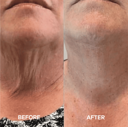🔥LAST DAY Buy 1 Get 1 Free🔥Nexisify Neck Masks™