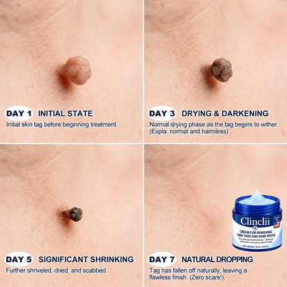 🎊🎊 Clinclii® 𝟕-𝐃𝐚𝐲 𝐒𝐤𝐢𝐧 𝐓𝐚𝐠 & 𝐒𝐩𝐨𝐭 𝐄𝐫𝐚𝐬𝐞𝐫 𝐂𝐫𝐞𝐚𝐦 (𝐙𝐞𝐫𝐨 𝐏𝐚𝐢𝐧, 𝐙𝐞𝐫𝐨 𝐒𝐜𝐚𝐫𝐬 𝐅𝐨𝐫𝐦𝐮𝐥𝐚)