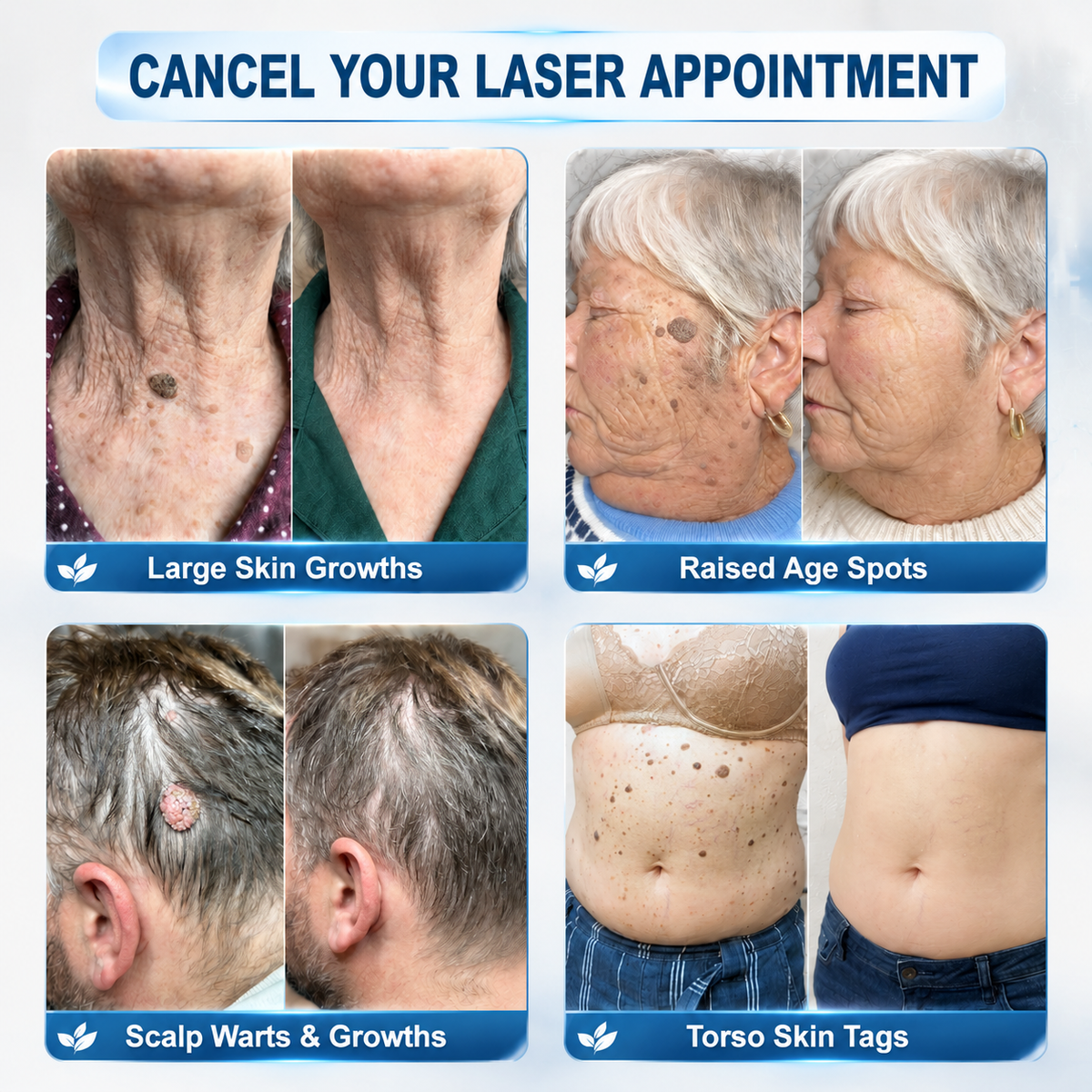 🎊🎊 Clinclii® 𝟕-𝐃𝐚𝐲 𝐒𝐤𝐢𝐧 𝐓𝐚𝐠 & 𝐒𝐩𝐨𝐭 𝐄𝐫𝐚𝐬𝐞𝐫 𝐂𝐫𝐞𝐚𝐦 (𝐙𝐞𝐫𝐨 𝐏𝐚𝐢𝐧, 𝐙𝐞𝐫𝐨 𝐒𝐜𝐚𝐫𝐬 𝐅𝐨𝐫𝐦𝐮𝐥𝐚)